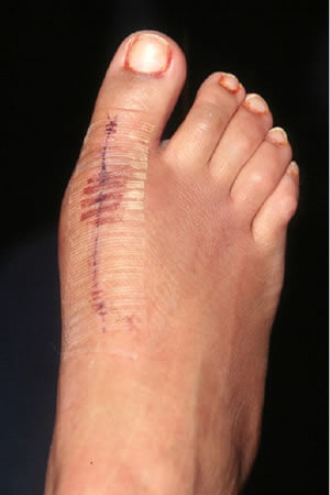 Bunion Removal, Surgery and Recovery in the Broward County, FL: Tamarac (Margate, Palm Aire, Coral Springs, Parkland, Coconut Creek, Sunrise, Lauderdale Lakes, Plantation, Lauderhill, Oakland Park, Wilton Manors, Pompano Beach, Hollywood, West Park, Miramar, Hallandale Beach) and Miami-Dade County, FL: North Miami Beach (Opa-locka, Westview, Palm Springs North, Miami Lakes, Miami Gardens, Aventura) and Miami (Fisher Island, Miami Beach, Coral Gables, Westchester, Hialeah, Key Biscayne, Fontainebleau) areas