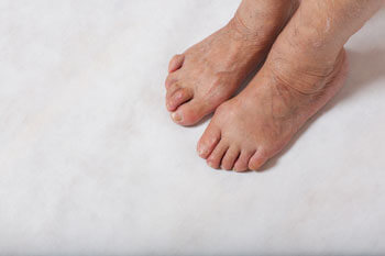 Hammertoe and mallet toe treatment in the Broward County, FL: Tamarac (Margate, Palm Aire, Coral Springs, Parkland, Coconut Creek, Sunrise, Lauderdale Lakes, Plantation, Lauderhill, Oakland Park, Wilton Manors, Pompano Beach, Hollywood, West Park, Miramar, Hallandale Beach) and Miami-Dade County, FL: North Miami Beach (Opa-locka, Westview, Palm Springs North, Miami Lakes, Miami Gardens, Aventura) and Miami (Fisher Island, Miami Beach, Coral Gables, Westchester, Hialeah, Key Biscayne, Fontainebleau) areas