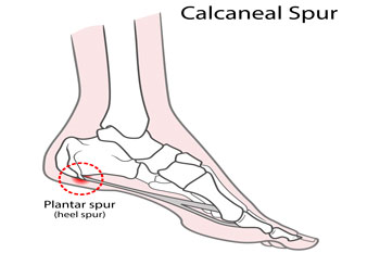 Heel spurs specialist in the Broward County, FL: Tamarac (Margate, Palm Aire, Coral Springs, Parkland, Coconut Creek, Sunrise, Lauderdale Lakes, Plantation, Lauderhill, Oakland Park, Wilton Manors, Pompano Beach, Hollywood, West Park, Miramar, Hallandale Beach) and Miami-Dade County, FL: North Miami Beach (Opa-locka, Westview, Palm Springs North, Miami Lakes, Miami Gardens, Aventura) and Miami (Fisher Island, Miami Beach, Coral Gables, Westchester, Hialeah, Key Biscayne, Fontainebleau) areas