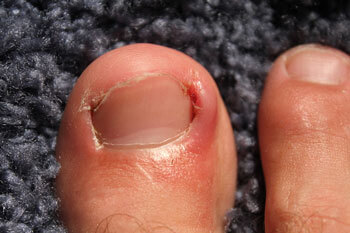 Ingrown toenails treatment in the Broward County, FL: Tamarac (Margate, Palm Aire, Coral Springs, Parkland, Coconut Creek, Sunrise, Lauderdale Lakes, Plantation, Lauderhill, Oakland Park, Wilton Manors, Pompano Beach, Hollywood, West Park, Miramar, Hallandale Beach) and Miami-Dade County, FL: North Miami Beach (Opa-locka, Westview, Palm Springs North, Miami Lakes, Miami Gardens, Aventura) and Miami (Fisher Island, Miami Beach, Coral Gables, Westchester, Hialeah, Key Biscayne, Fontainebleau) areas