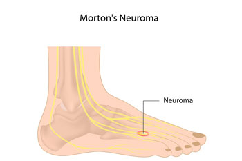 Mortons' neuroma treatment in the Broward County, FL: Tamarac (Margate, Palm Aire, Coral Springs, Parkland, Coconut Creek, Sunrise, Lauderdale Lakes, Plantation, Lauderhill, Oakland Park, Wilton Manors, Pompano Beach, Hollywood, West Park, Miramar, Hallandale Beach) and Miami-Dade County, FL: North Miami Beach (Opa-locka, Westview, Palm Springs North, Miami Lakes, Miami Gardens, Aventura) and Miami (Fisher Island, Miami Beach, Coral Gables, Westchester, Hialeah, Key Biscayne, Fontainebleau) areas