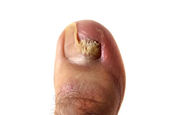 Toenail fungus treatment and restorations in the Broward County, FL: Tamarac (Margate, Palm Aire, Coral Springs, Parkland, Coconut Creek, Sunrise, Lauderdale Lakes, Plantation, Lauderhill, Oakland Park, Wilton Manors, Pompano Beach, Hollywood, West Park, Miramar, Hallandale Beach) and Miami-Dade County, FL: North Miami Beach (Opa-locka, Westview, Palm Springs North, Miami Lakes, Miami Gardens, Aventura) and Miami (Fisher Island, Miami Beach, Coral Gables, Westchester, Hialeah, Key Biscayne, Fontainebleau) areas class=