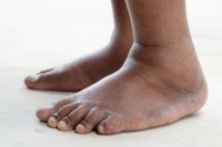 Causes of Swelling in the Feet