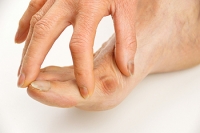 Are Bunions Noticeable?