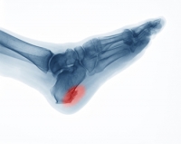 Why Do Heel Spurs Occur?